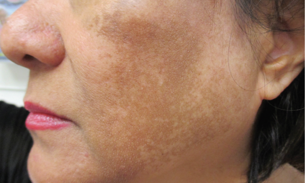 melasma