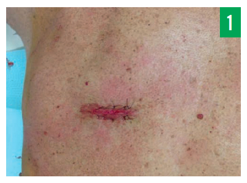 Rhabdomyoma