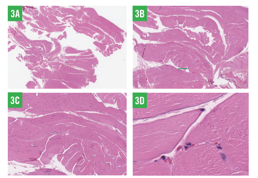 Rhabdomyoma