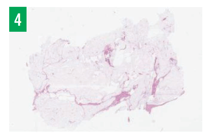 Rhabdomyoma