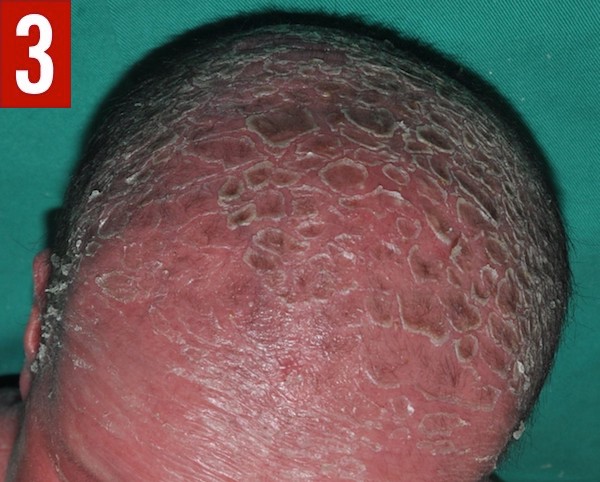 Netherton syndrome figure 3