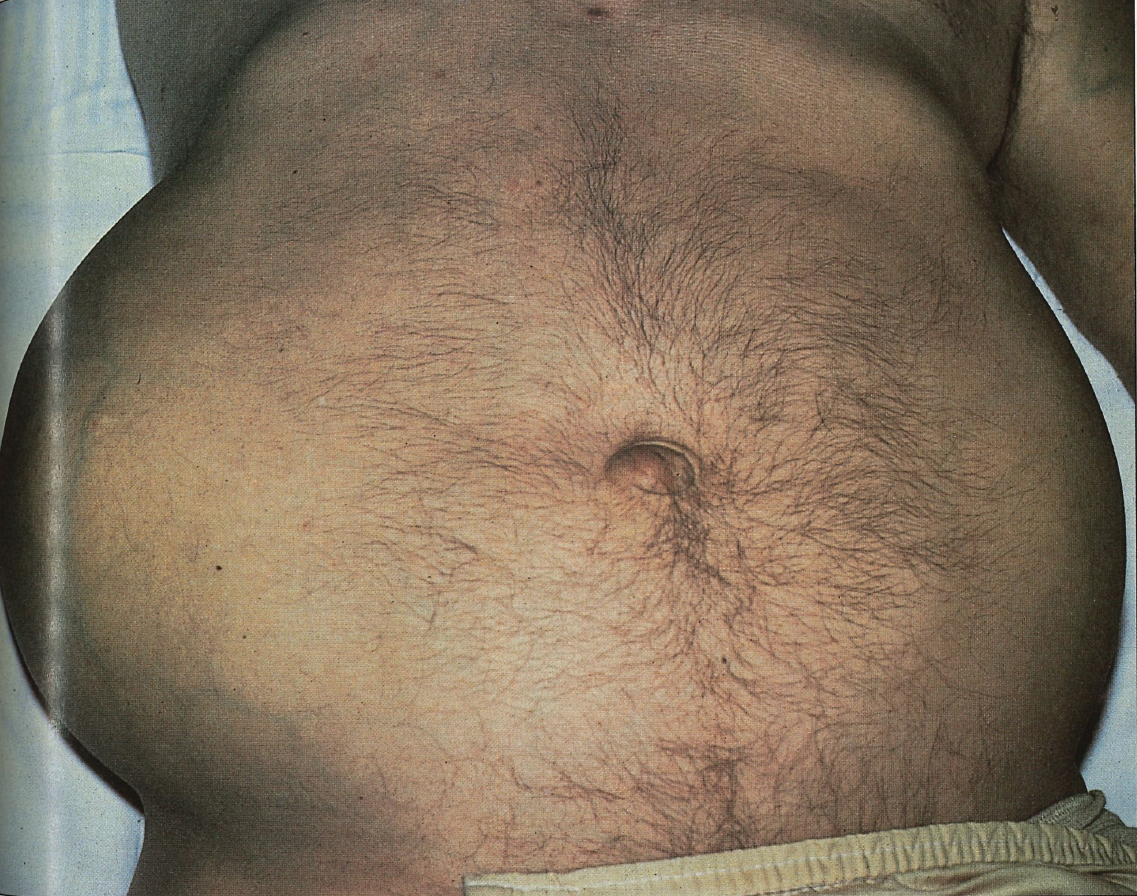 ADPKD clinical image