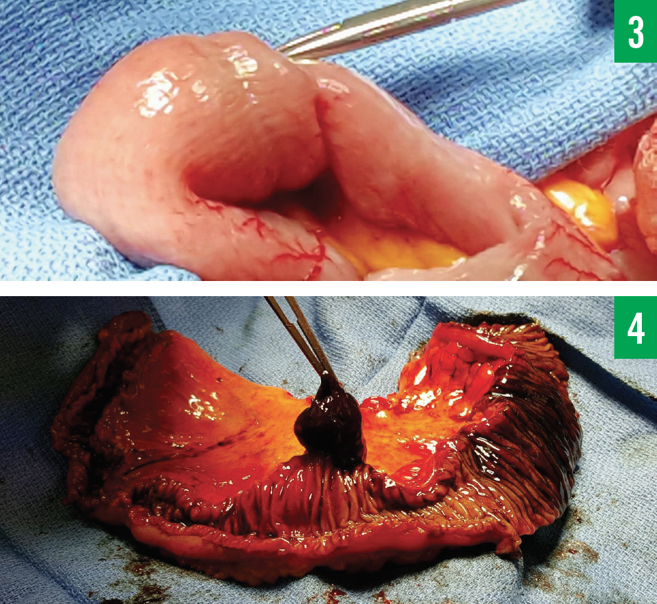 Angiosarcoma of the Small Intestine Figures 3 + 4