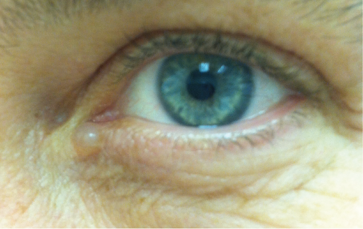 Apocrine Hidrocystoma eye