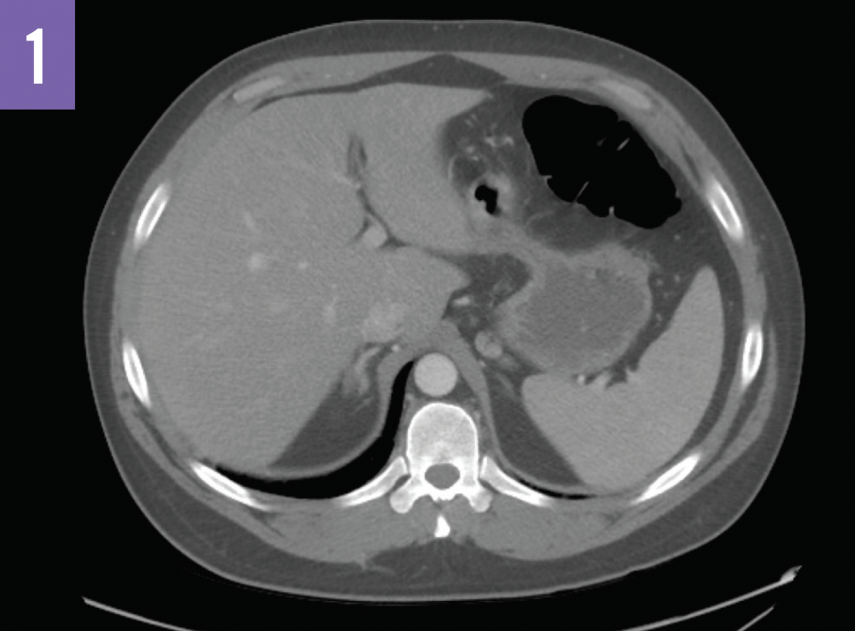 Bilateral Adrenal Hemorrhage Figure 1