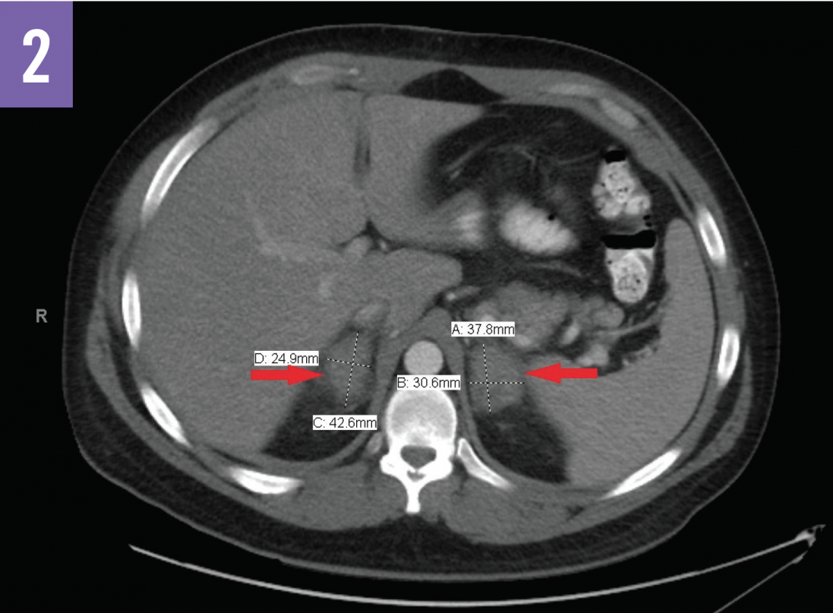 Bilateral Adrenal Hemorrhage Figure 2