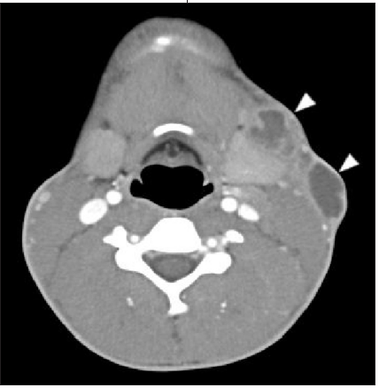 ct scan of neck mass