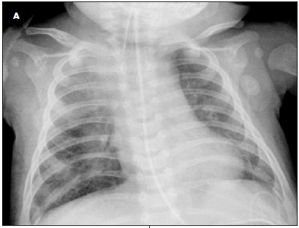 chest radiograph