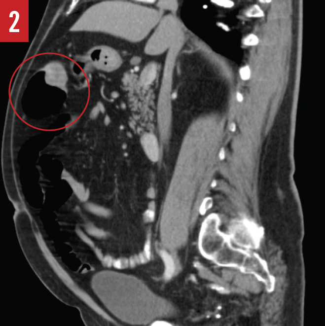 Colorectal cancer figure 2