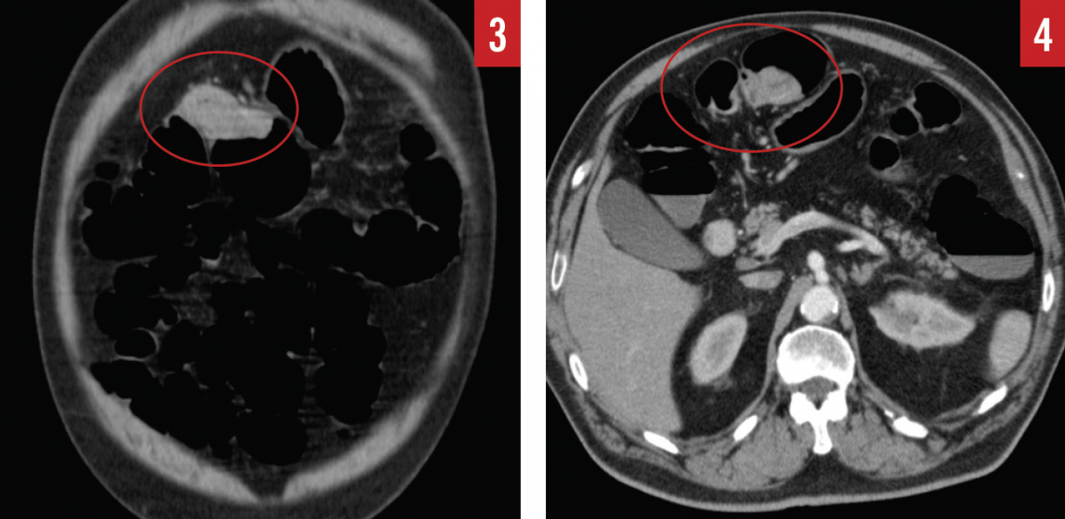 Colorectal cancer screening figures 3 and 4