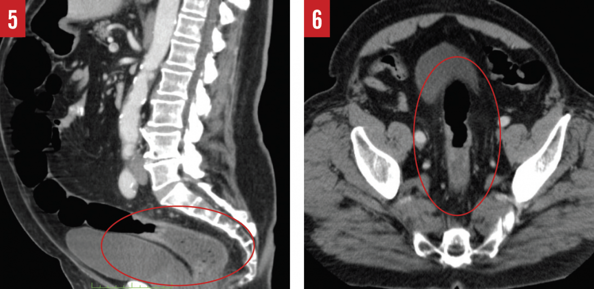 Colorectal cancer screening figures 5 and 6