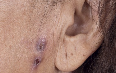 patient's cheek resolving