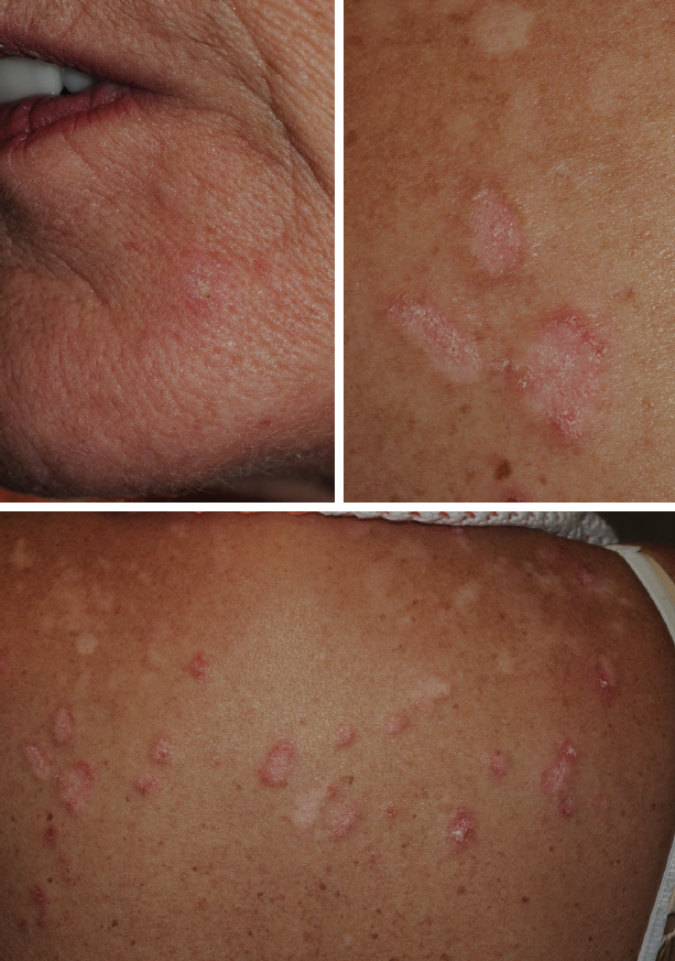 Cutaneous lupus erythematosus figures 1 2 3 vertical