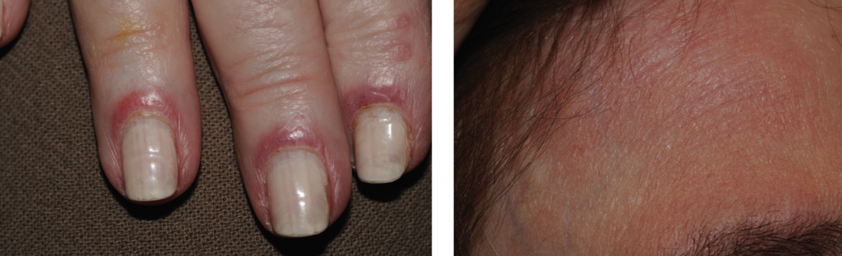 Cutaneous lupus erythematosus