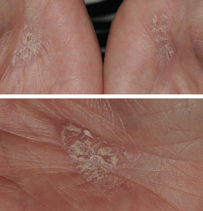 DermClinic 1 psoriasis