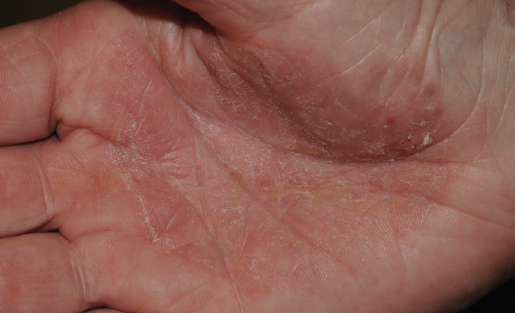 DermClinic 2 psoriasis 2