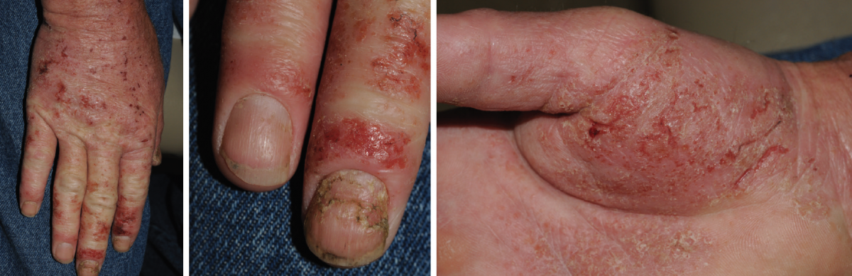 DermClinic 3 psoriasis