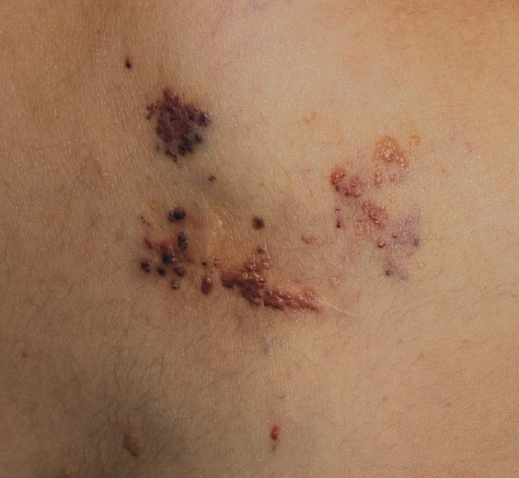 Lymphangioma circumscriptum