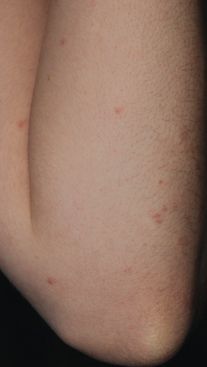 guttate psoriasis