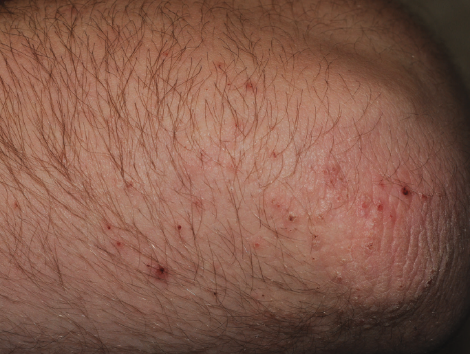 Summertime Pityriasis