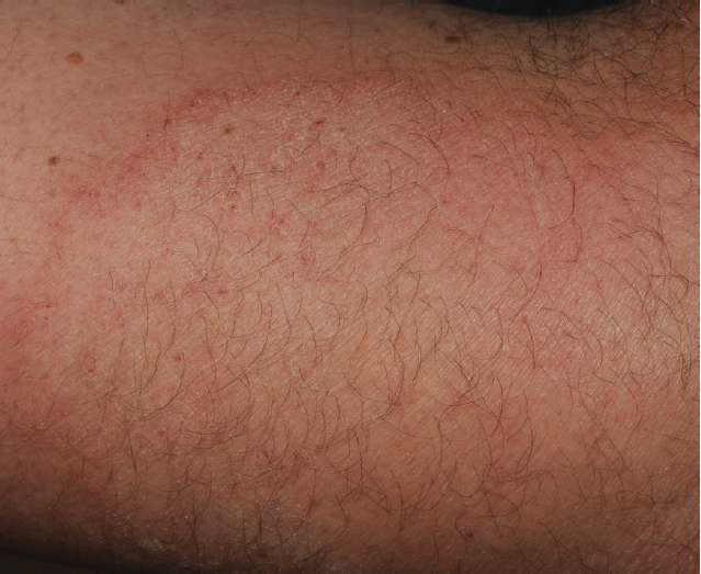 Eczema arm