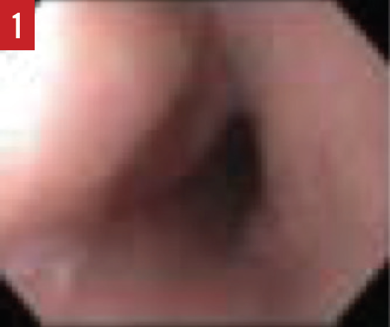 Eosinophilic Esophagitis Figure 1