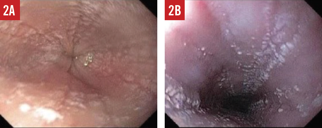 endoscopic features of EoE