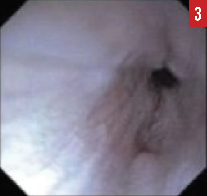 EGD image; esophageal stricture