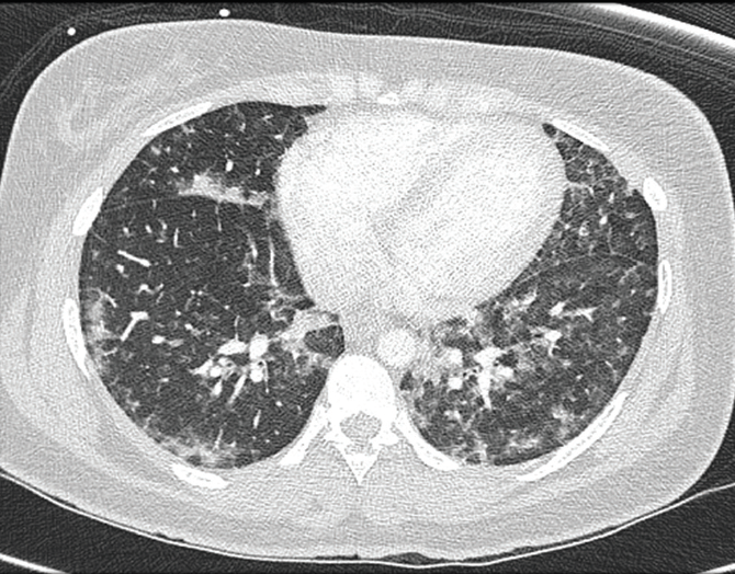 Evans syndrome figure