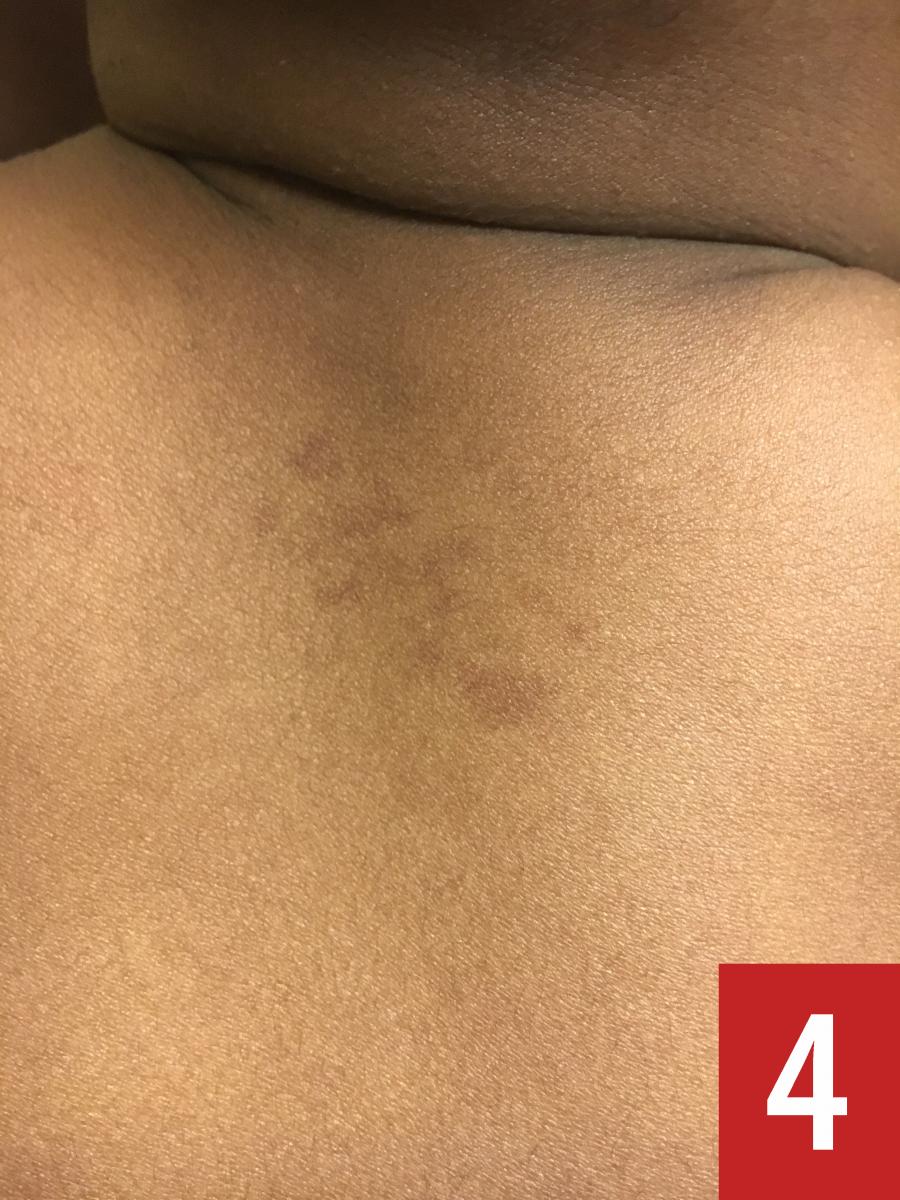 cafe au lait macule on the chest