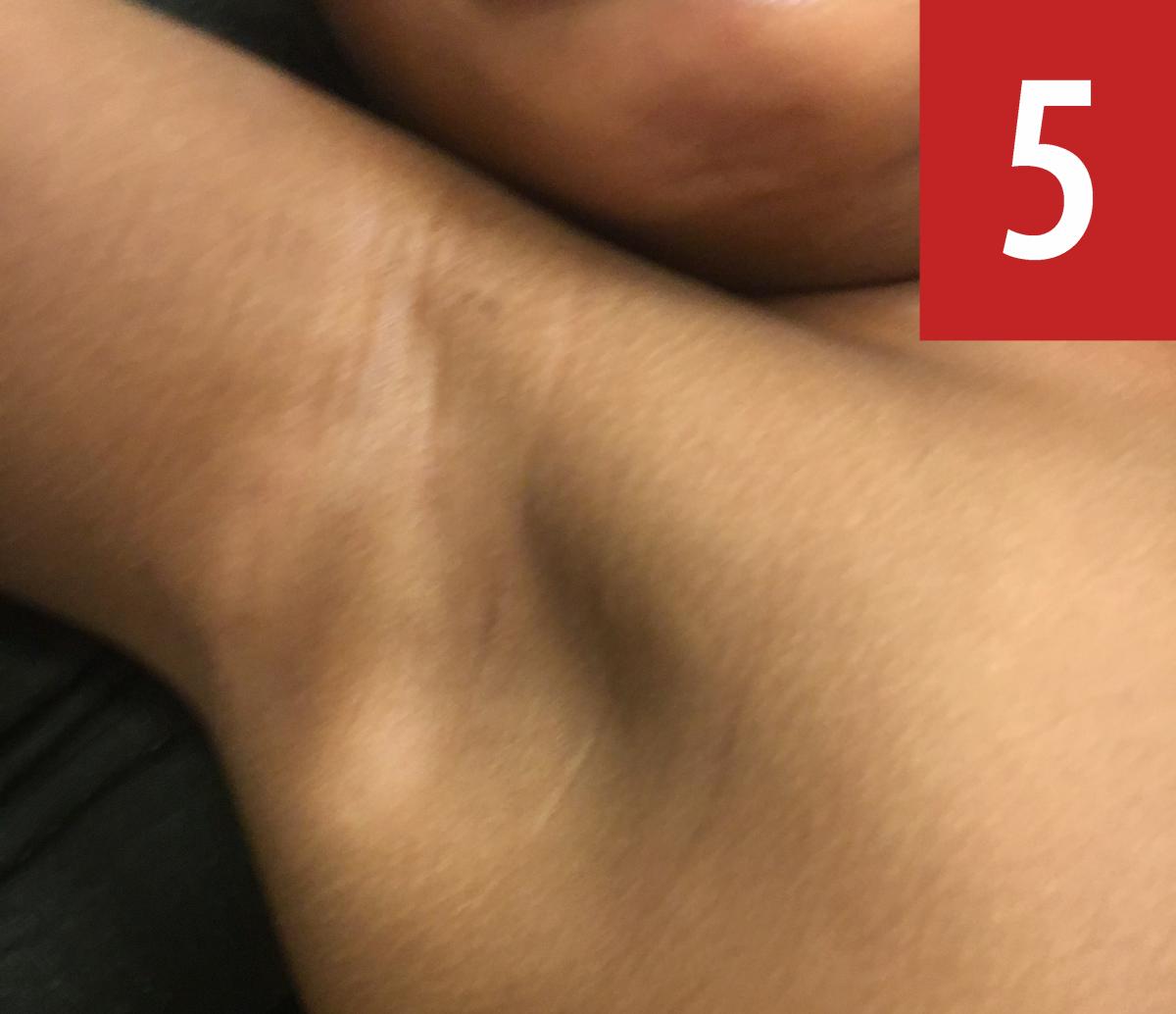 café au lait macules and vitiligo on the right axillae