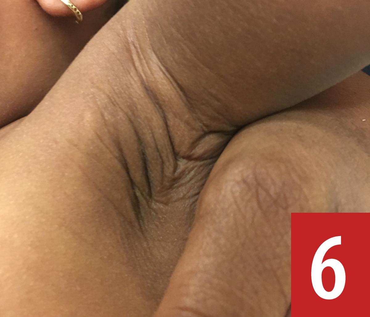 café au lait macules on the left axilla