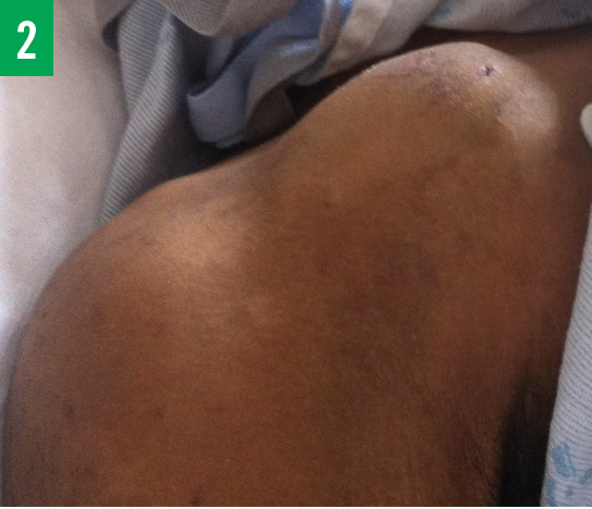 masses on the shoulder