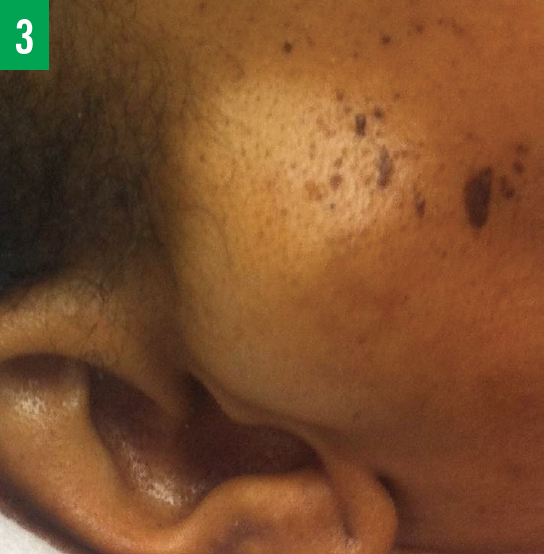 masses on the tragus