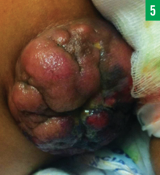 erythematous breasts