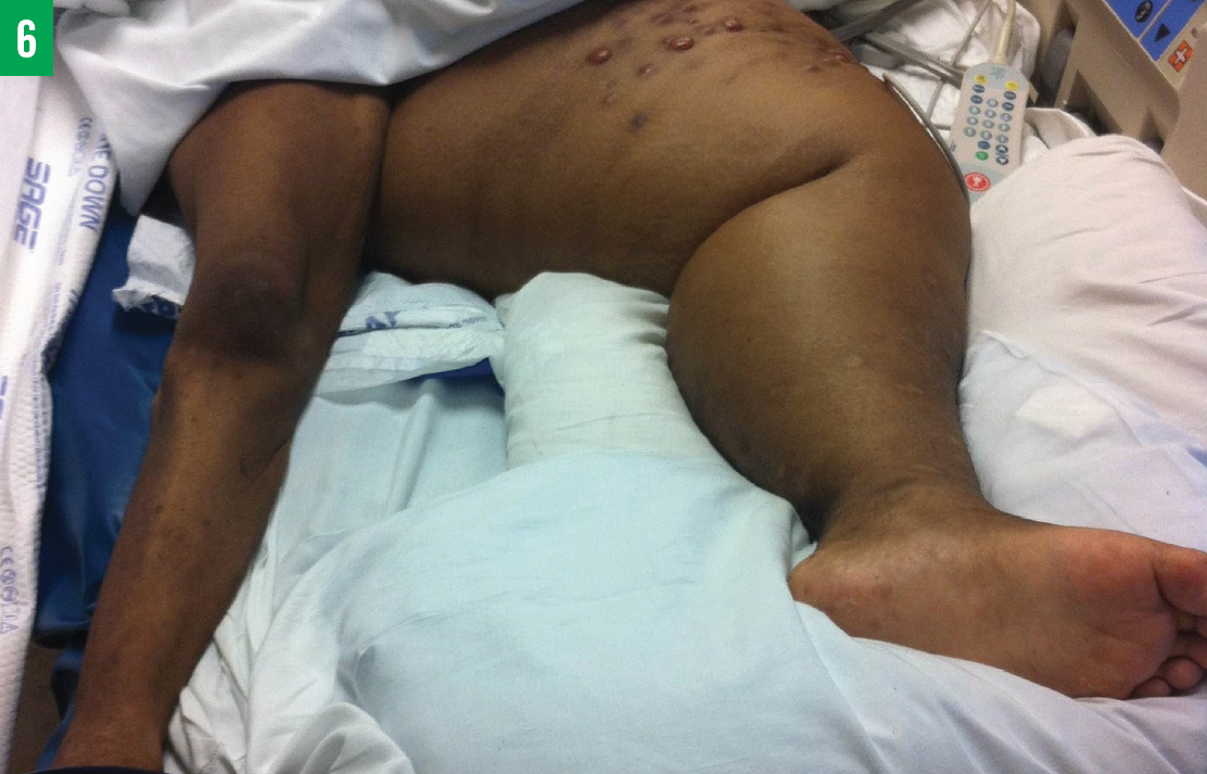 lower extremity lymphatic involvement 