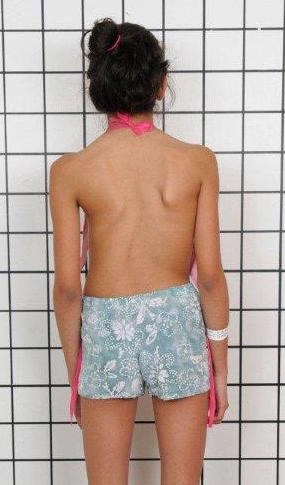 scoliosis figure 1