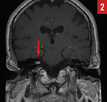 Figure 2 acoustic neuroma
