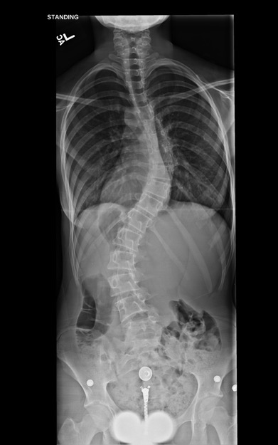scoliosis figure 3