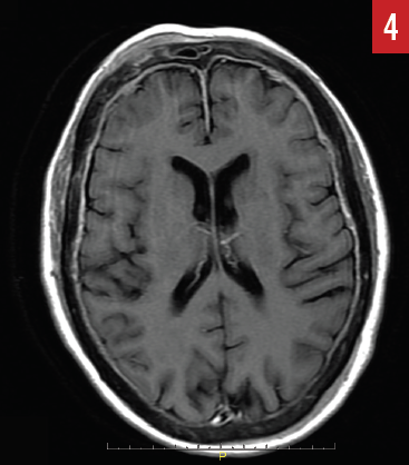 Figure 4 calvarial metastatic disease