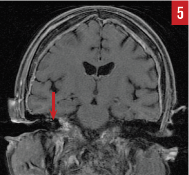Figure 5 epidural disease