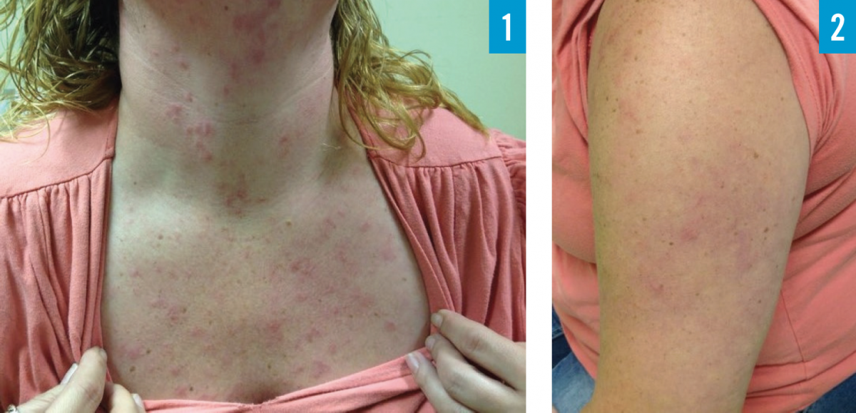 Tumid Lupus Erythematosus figures 1 and 2