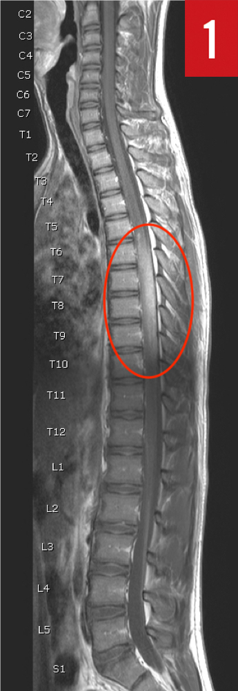 MRI of the spine