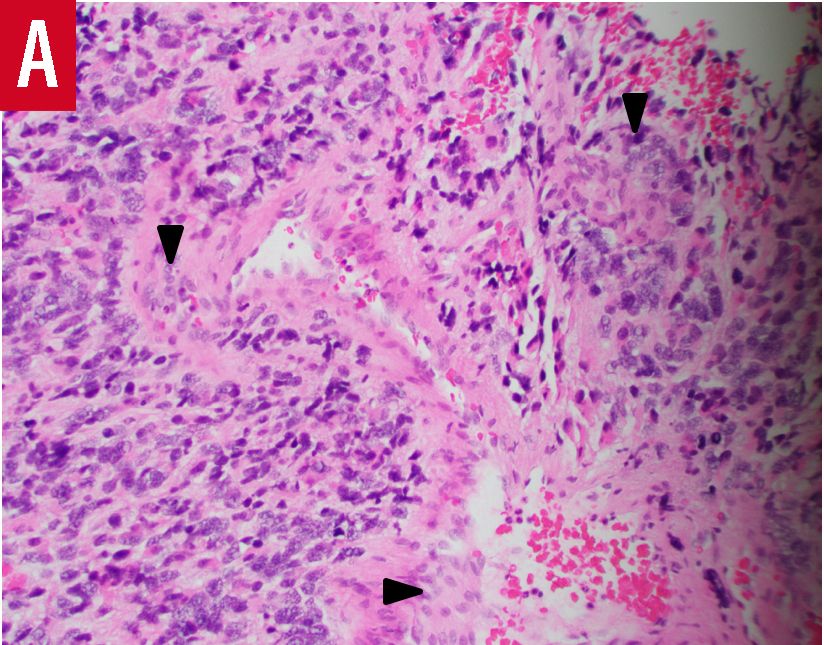 glioblastoma biopsy results, panel A
