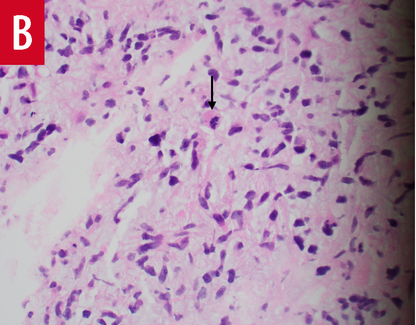 glioblastoma biopsy results, panel B
