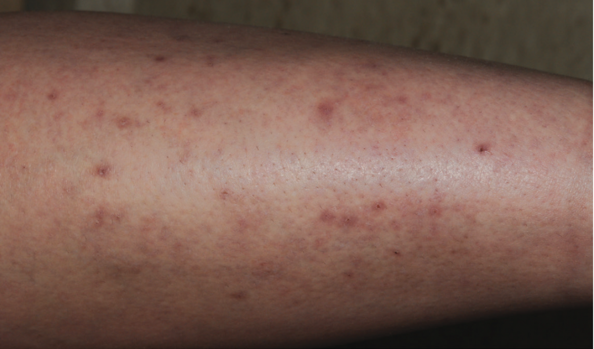 Hodgkin lymphoma arm