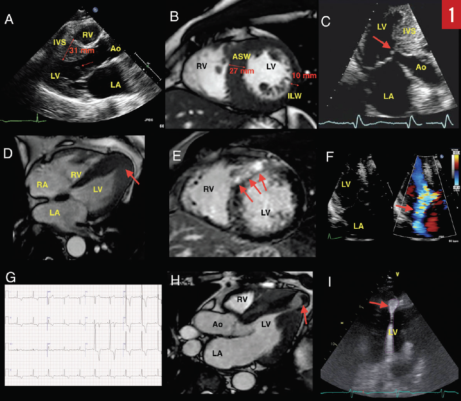 Hypertrophic Cardiomyopathy