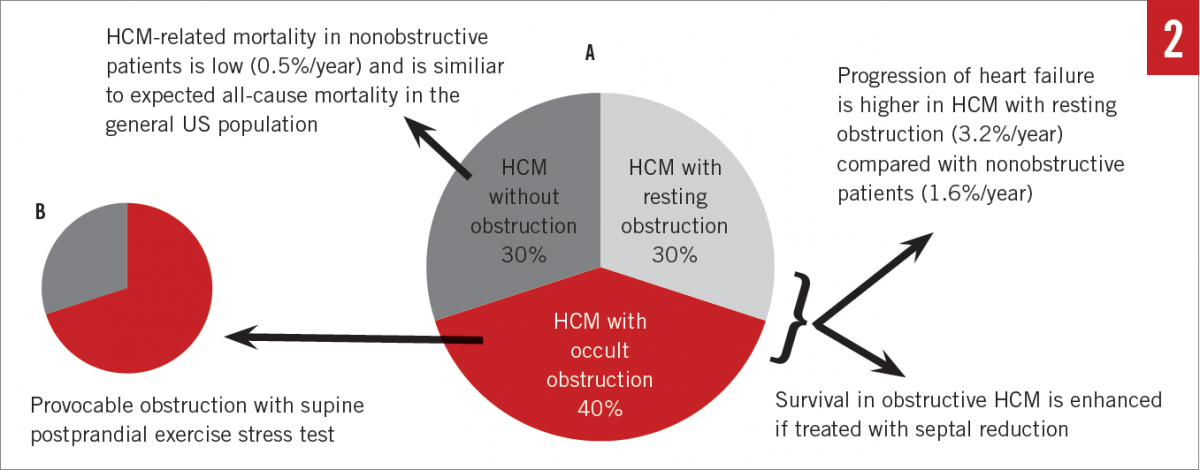 Hypertrophic Cardiomyopathy