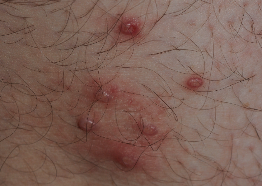 Molluscum contagiosum