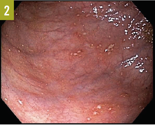Endoscopic view cecum